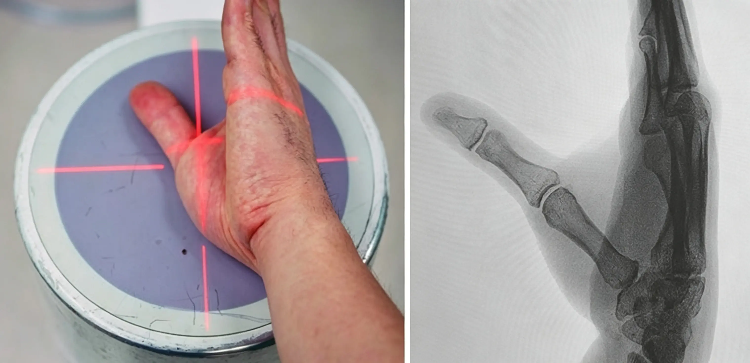 Roberts positioning radiograph (1) (1)