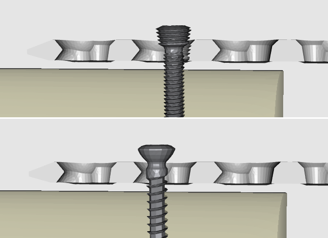 locking screw.png