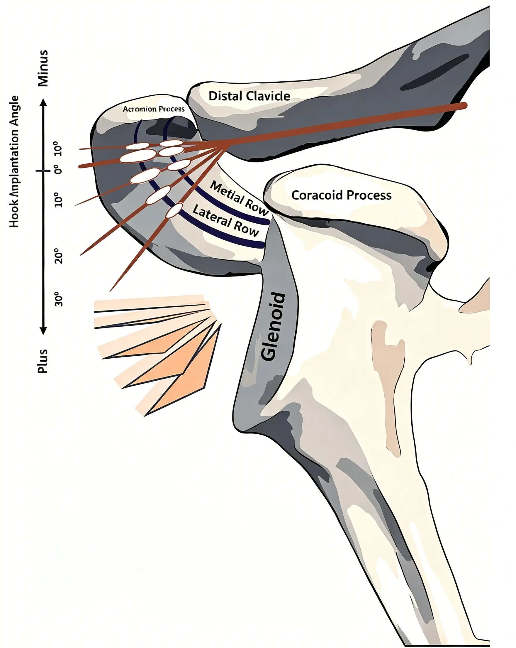 Different placement positions and angles of the clavicular hook (1) (1).webp