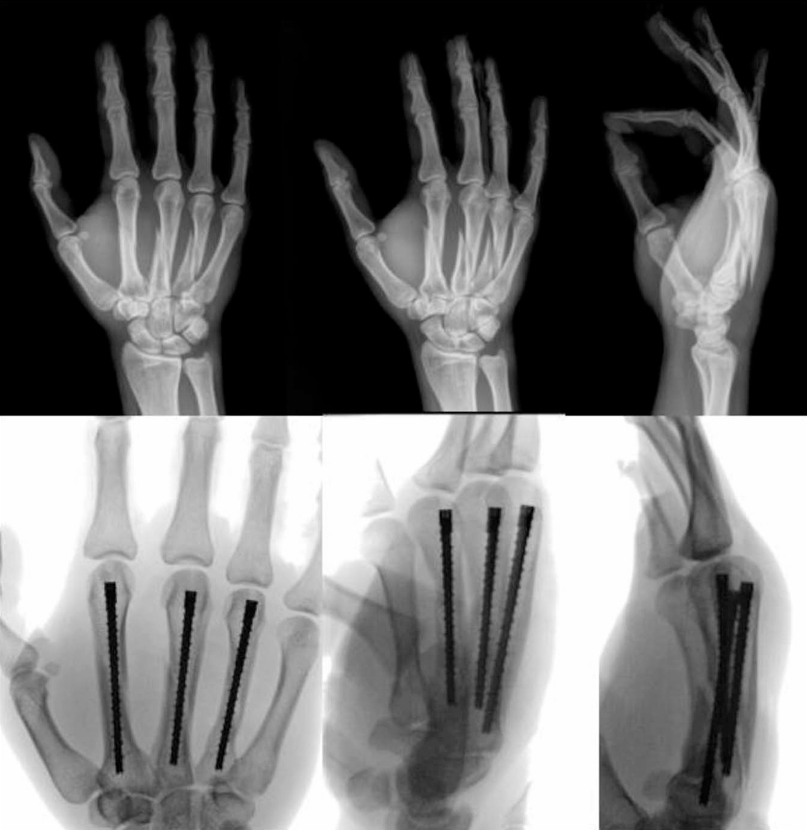 Intramedullary Screw Fixation.png