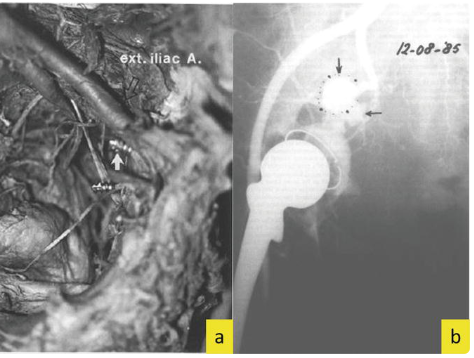 Vessel injury examples.png