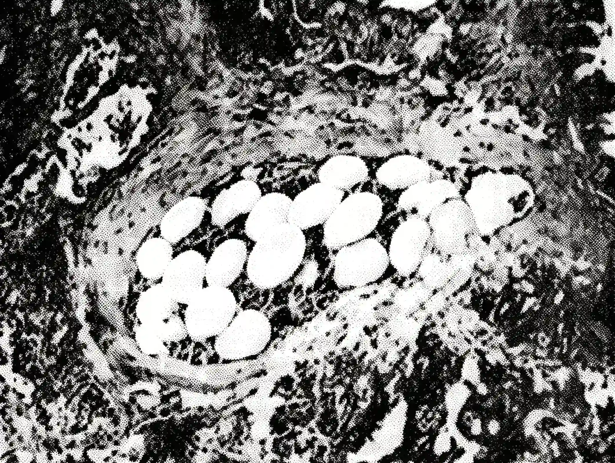Pulmonary bone marrow microembolism.webp