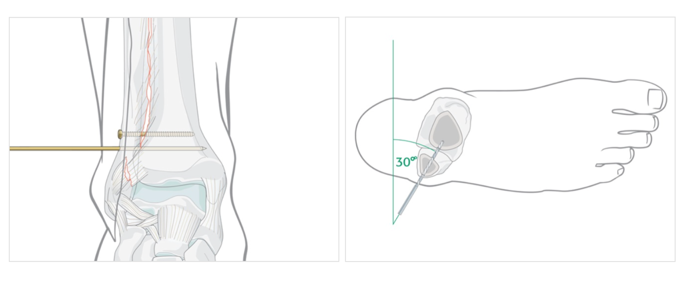 Illustration of syndesmotic screw placement.png