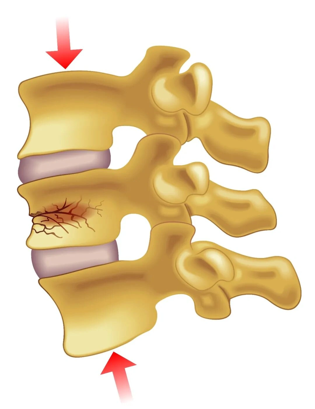 Vertebral fracture