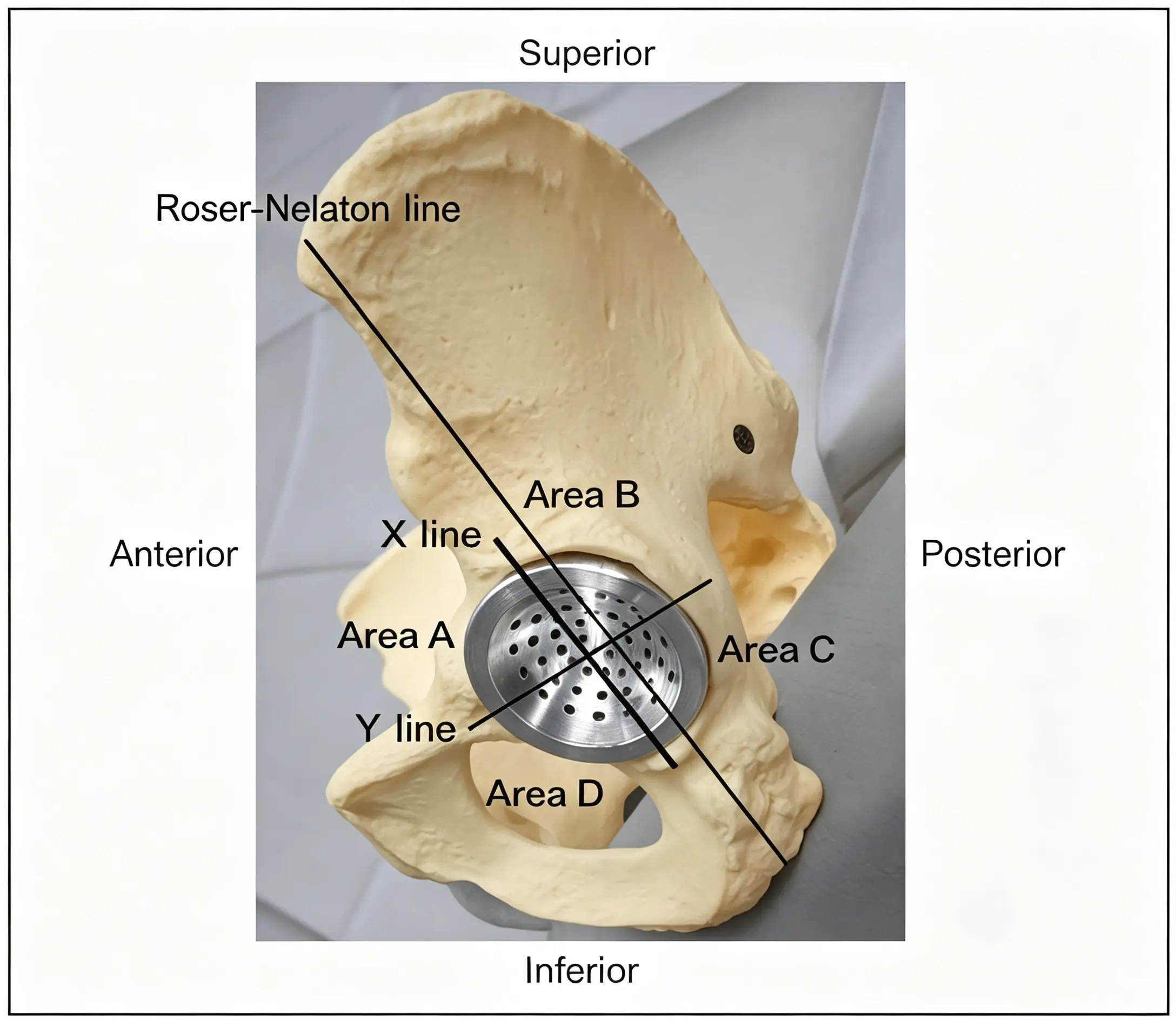 Acetabular measuring cup and acetabular zoning
