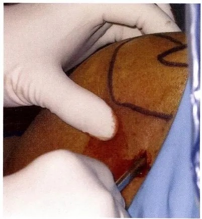 Arthroscope insertion