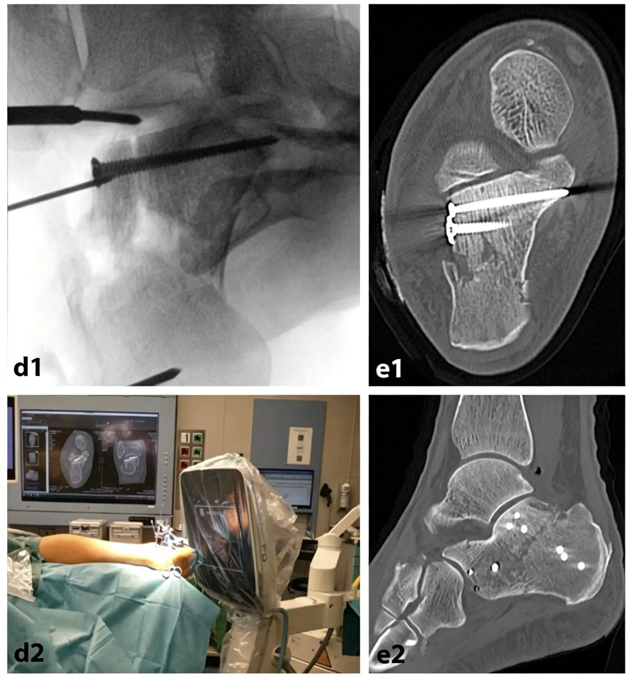 Postoperative coronal reconstruction CT (1) (1)