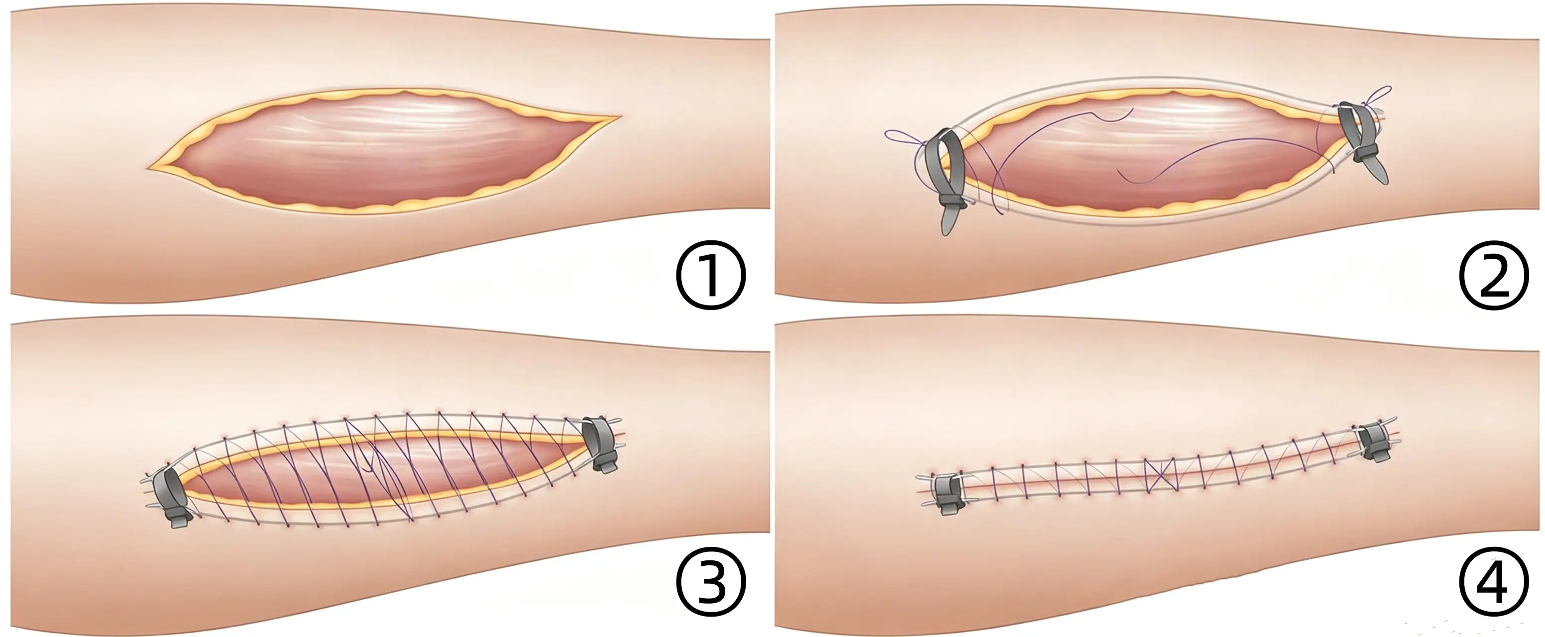 PDS suture.webp