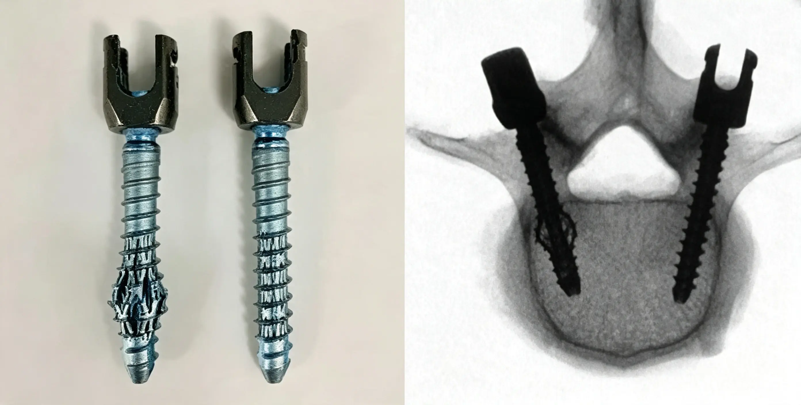 Expandable pedicle screw.webp
