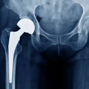 Total hip replacement system.webp