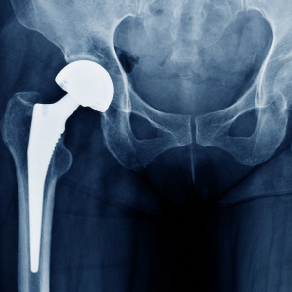 Total hip replacement system.webp