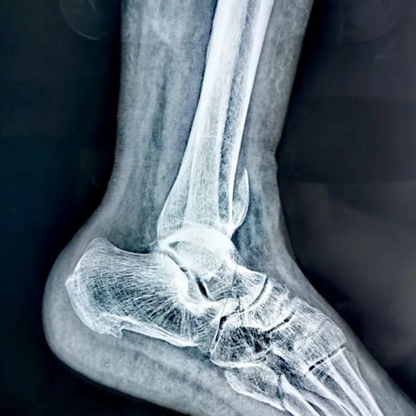ankle fracture.jpg