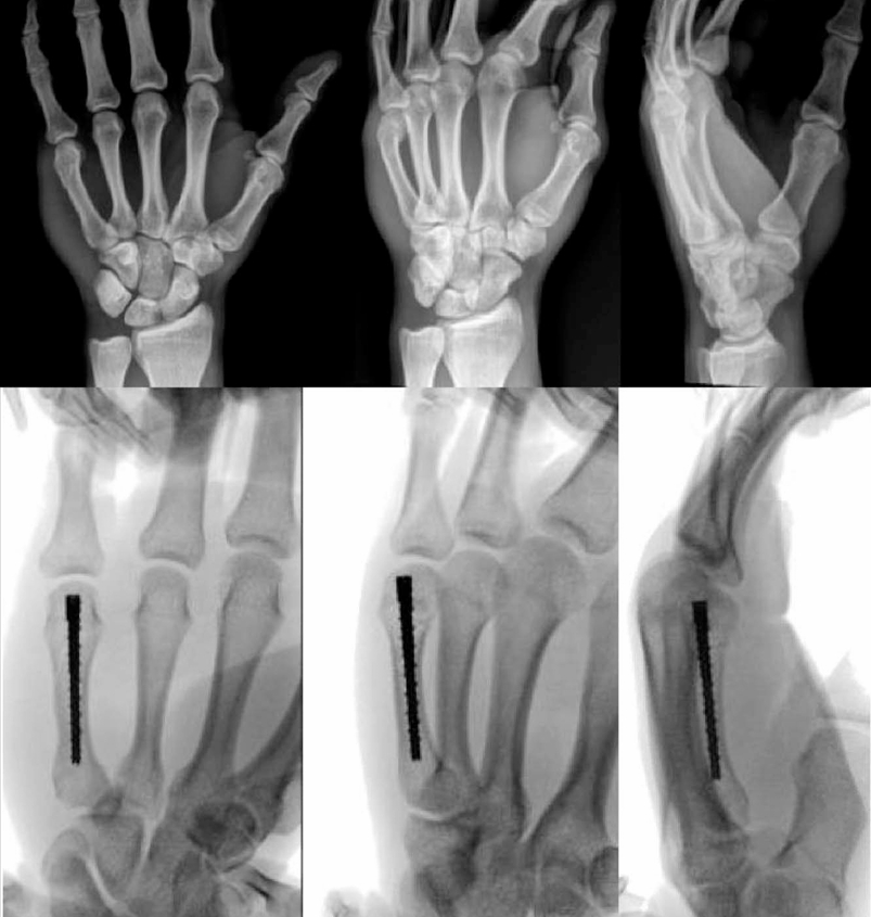 Intramedullary Screw Fixation.png