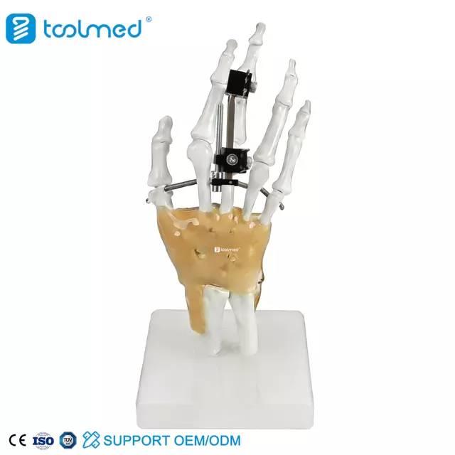 Mini Fragment External Fixator (Finger and Palm) 5100-0103