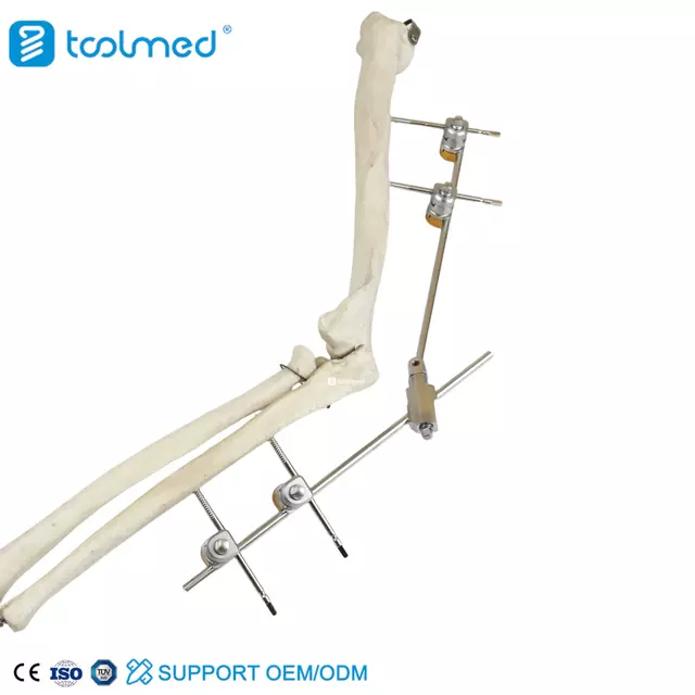 Ulna & Radius External Fixator