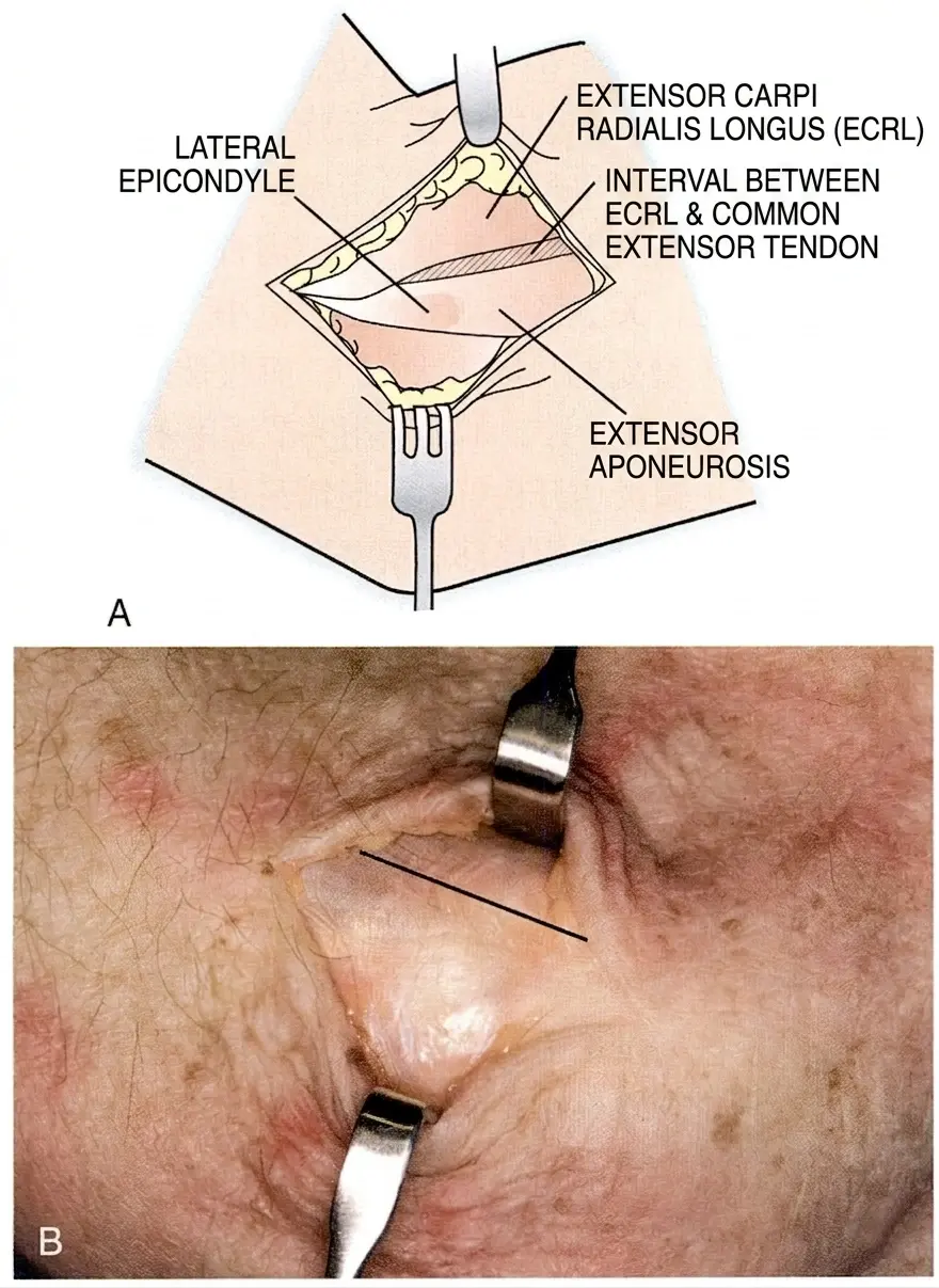 Skin Incision (1) (1).webp