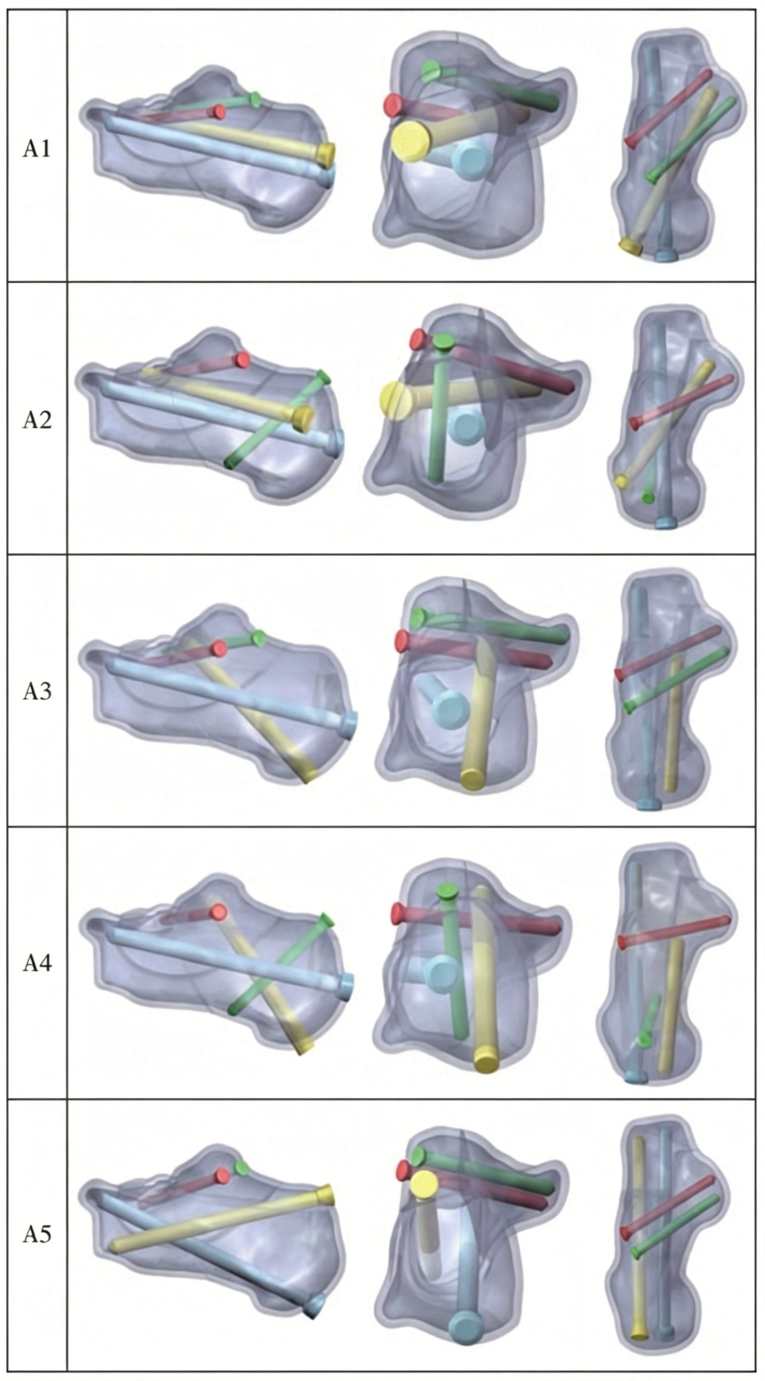 Tongue-type fracture model.webp