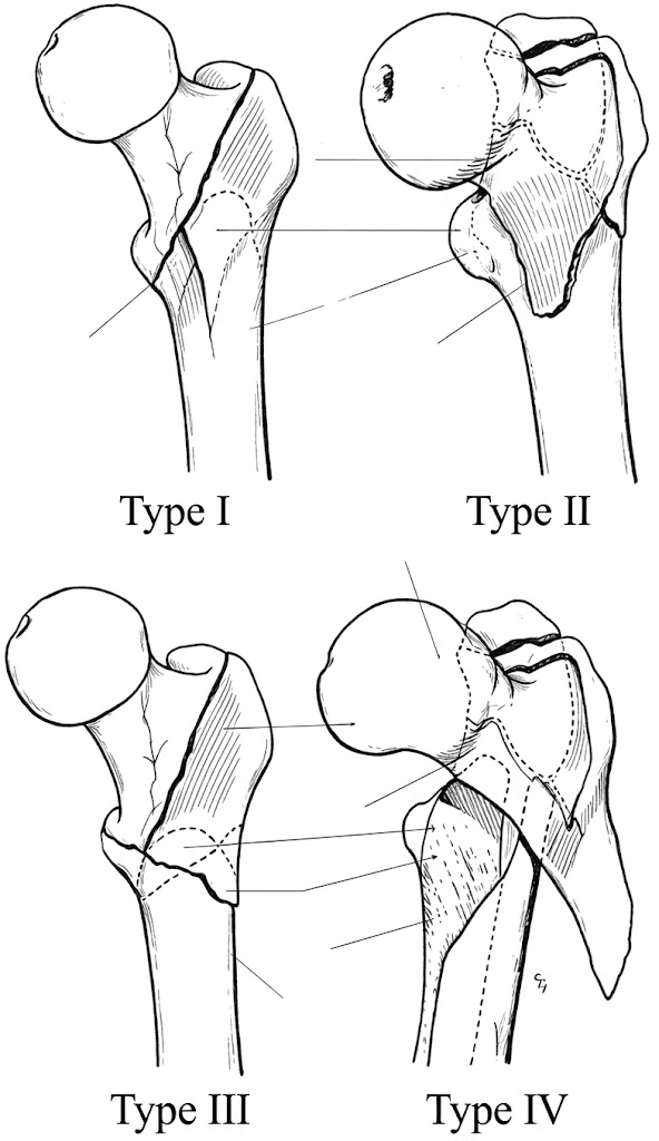 Boyd and Griffin classification