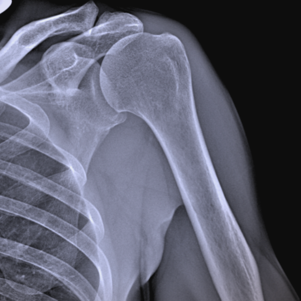 Shoulder arthroscopic surgery.png