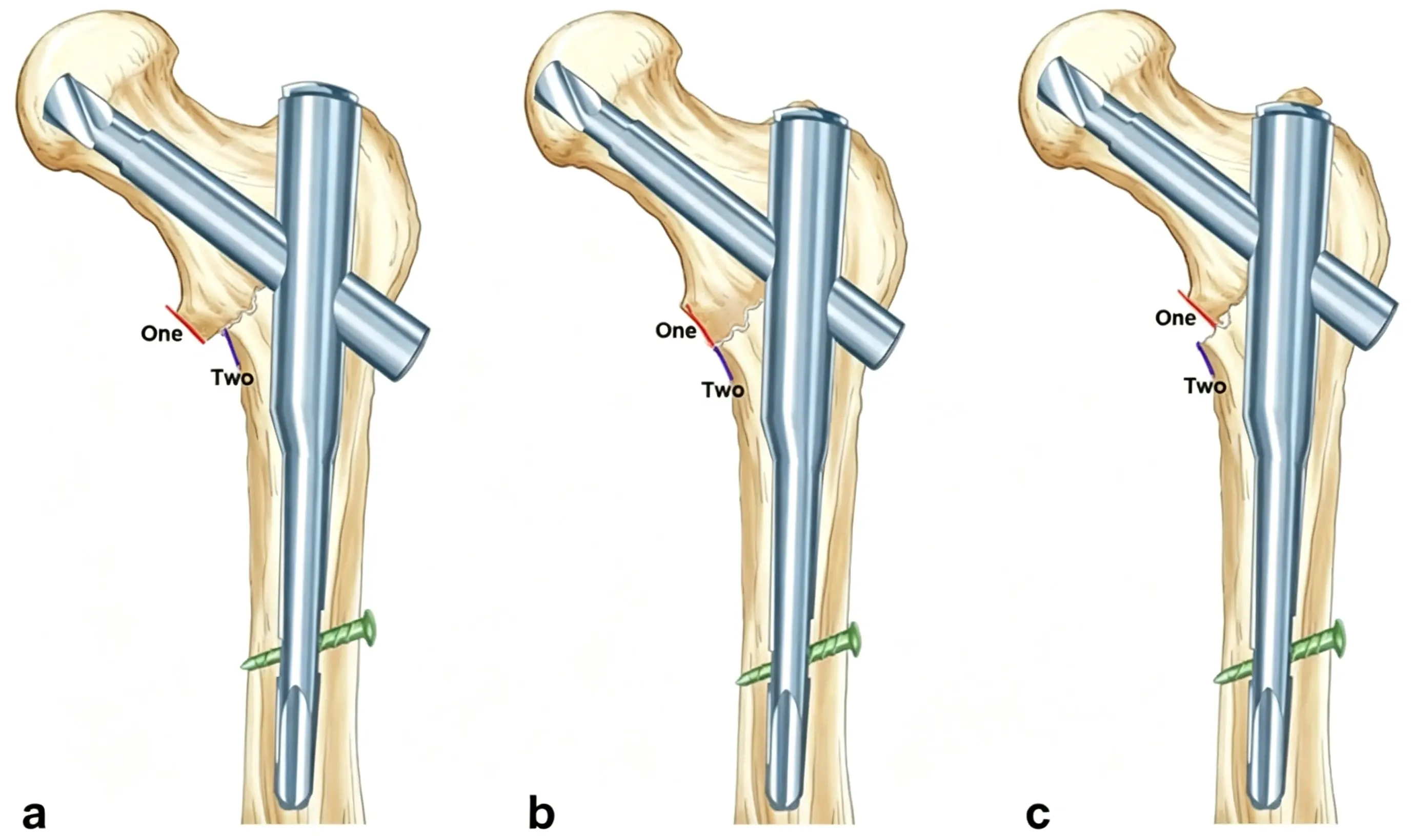 AP view of the hip fracture