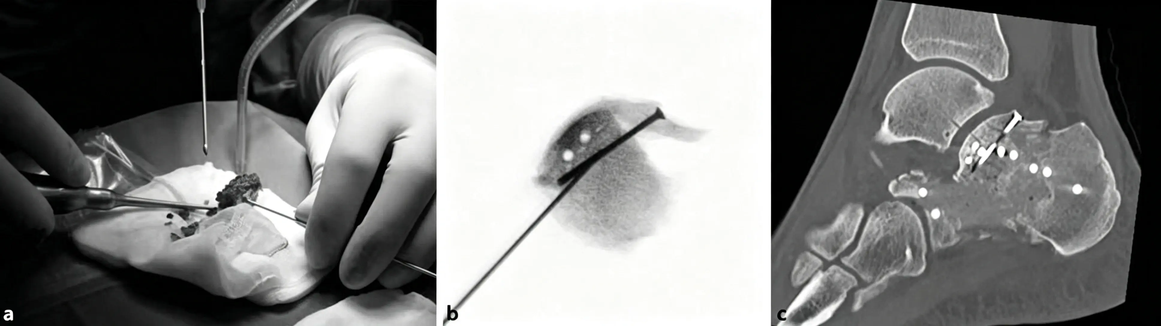 In vitro reconstruction of the posterior facet of the subtalar joint (1) (1)