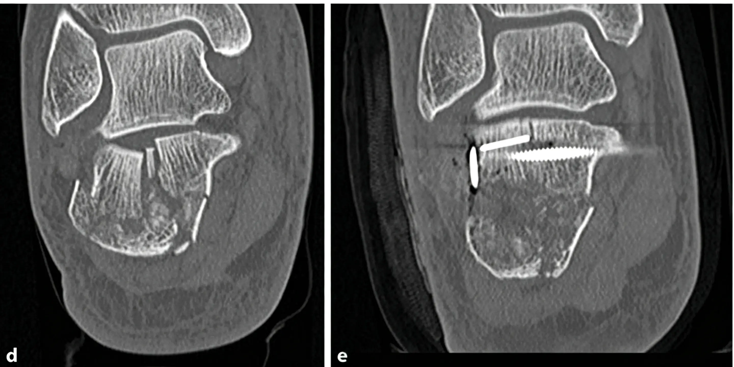 Intraoperative lateral fluoroscopic view of the K-wire (1) (1)