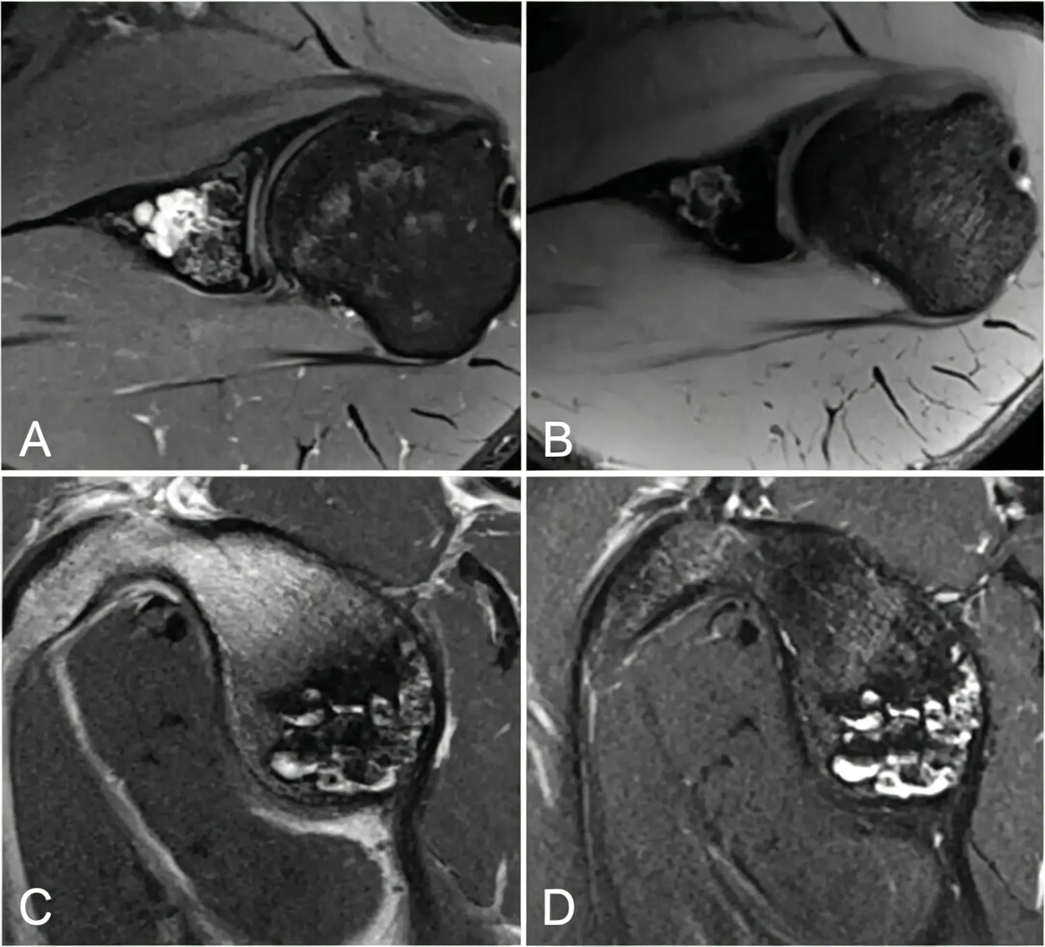 shoulder MRI examination.webp