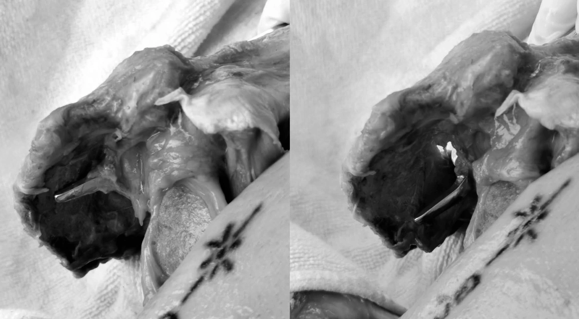 The position of the hook when placed at different angles beneath the acromion 2.webp