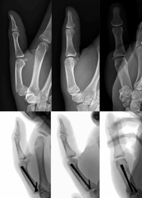 Percutaneous Intramedullary Fixation.png