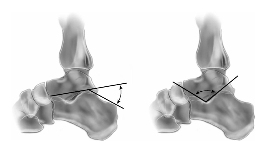B&ouml;hler angle & Gissane angle.webp