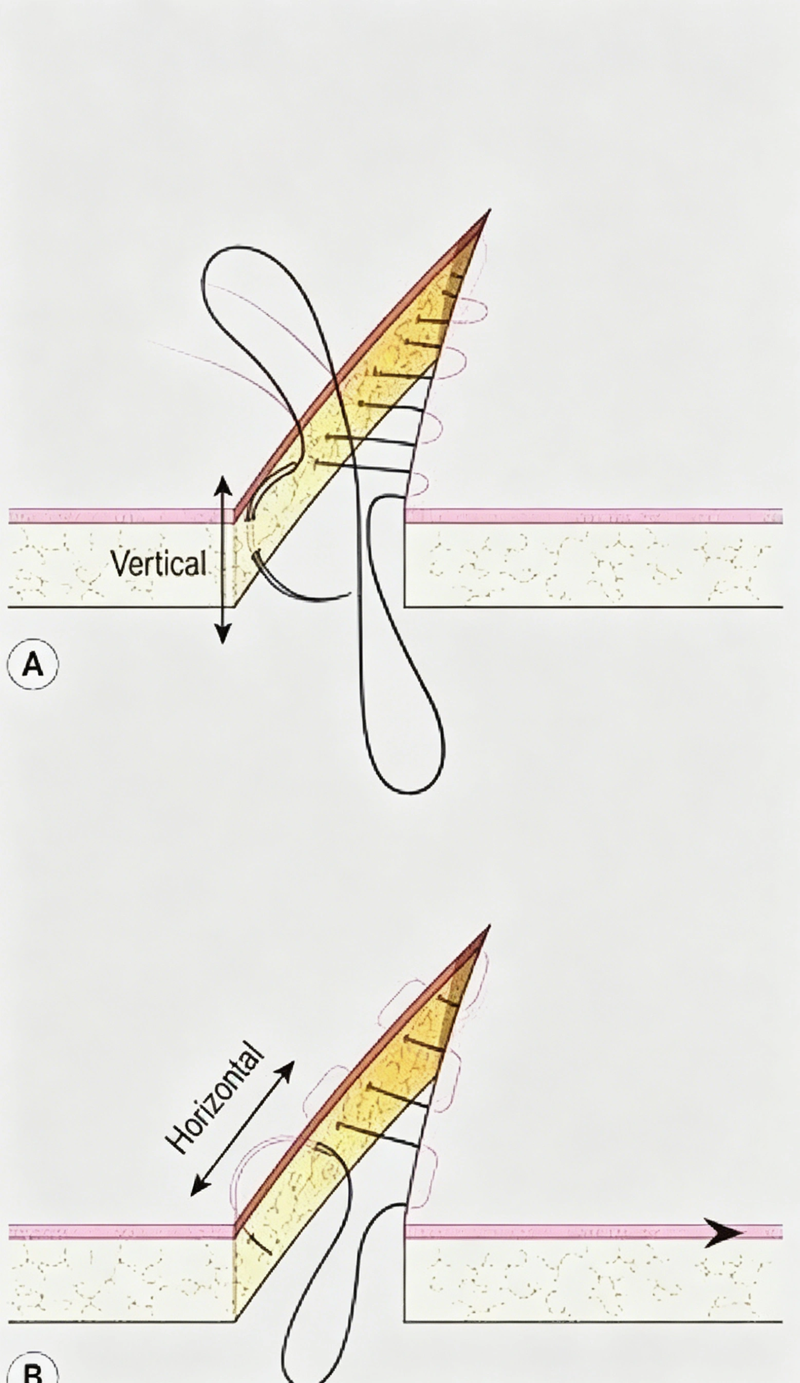 Horizontal Mattress Sutures.webp