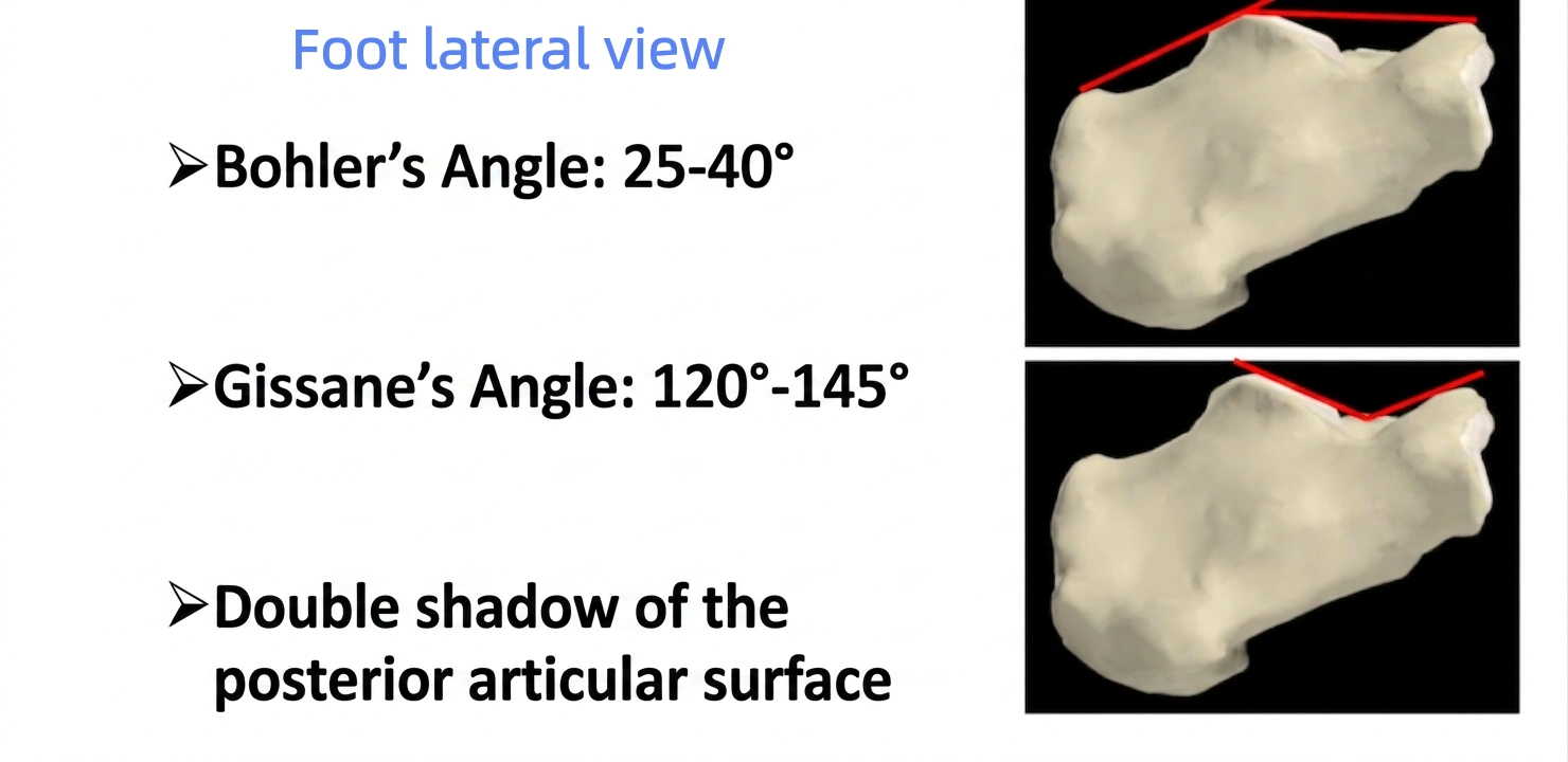 Foot lateral view (1).webp