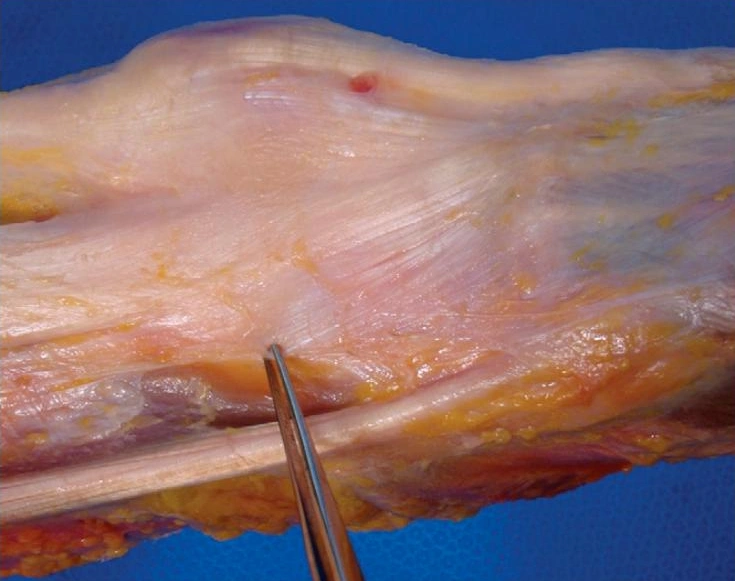 แถบ Iliotibial (ITB) 1