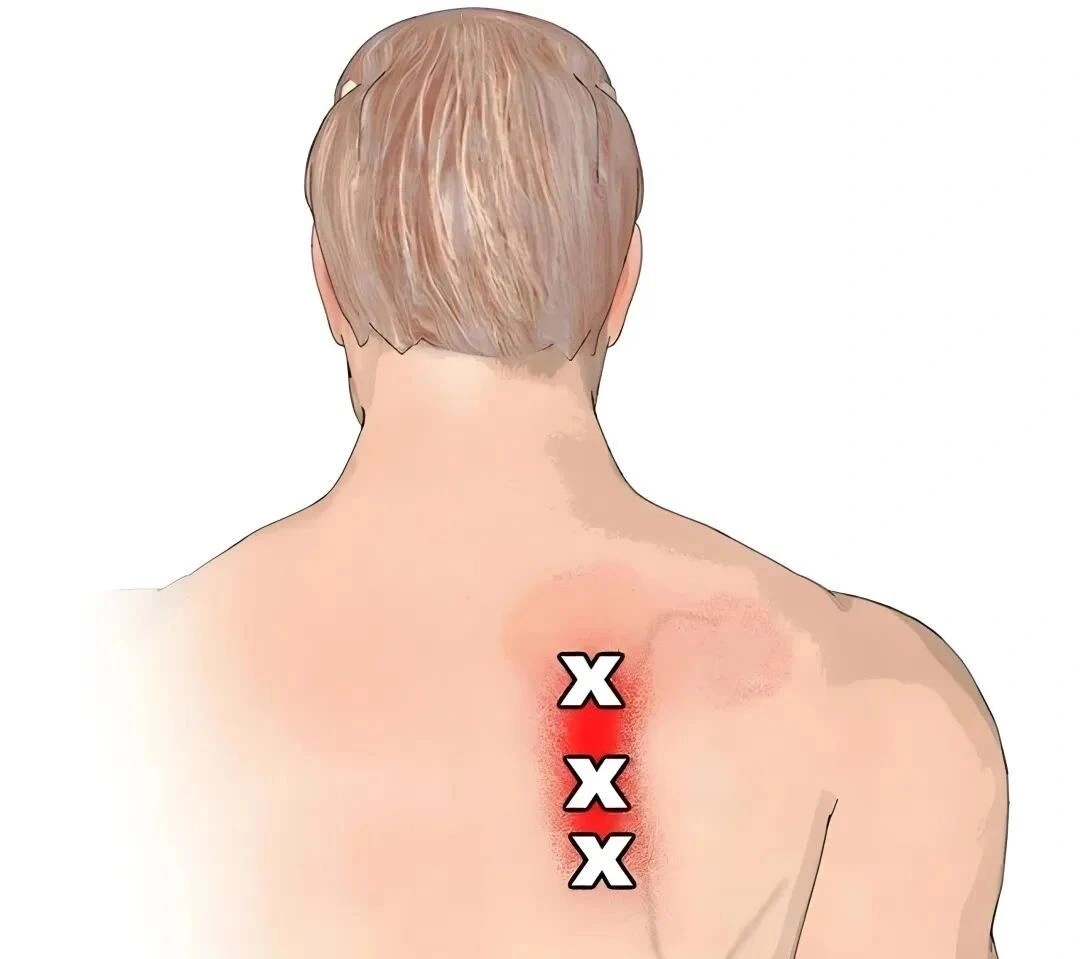 rhomboid muscle strain