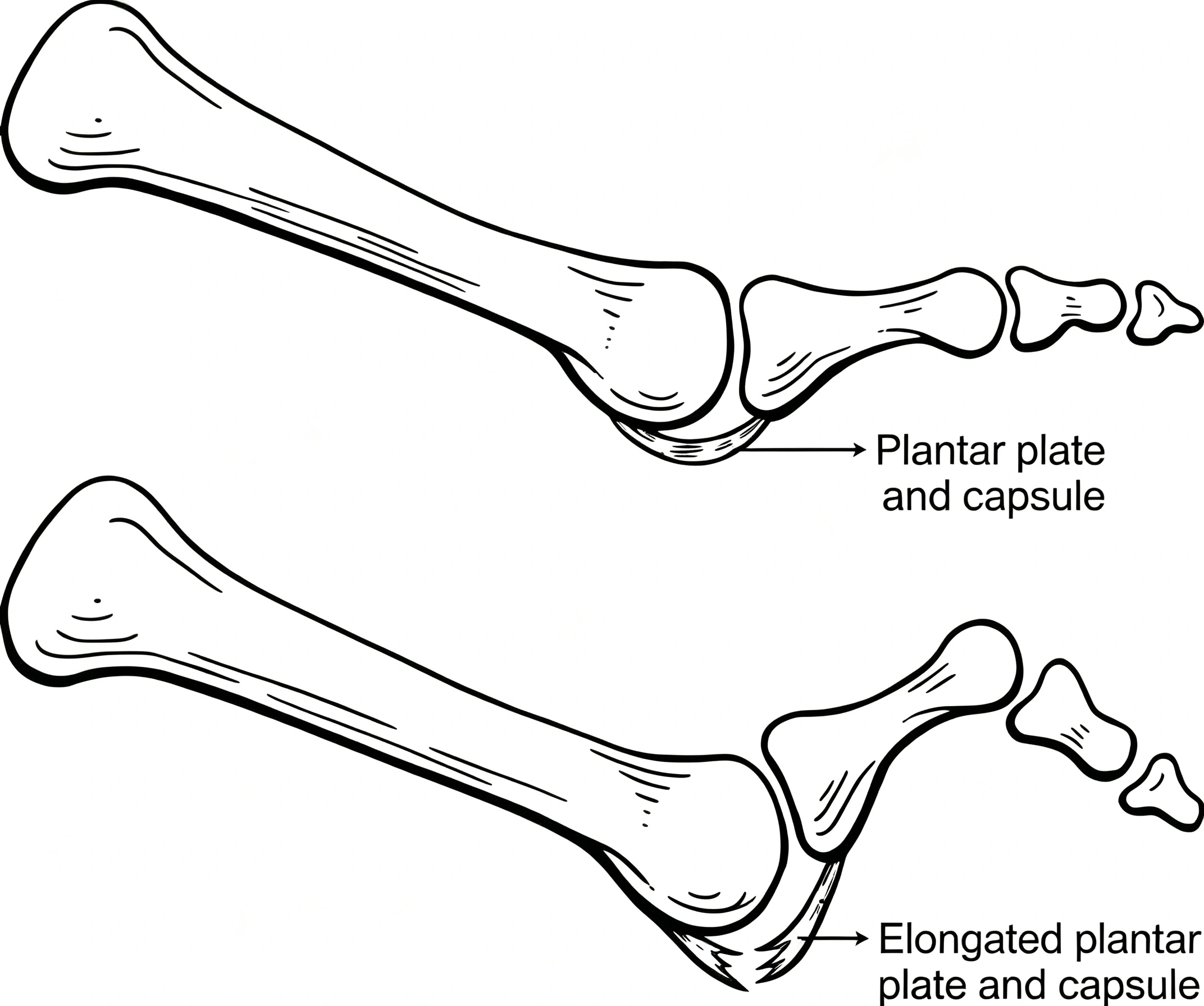 hammertoes