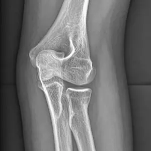Pediatric radial neck fracture.webp