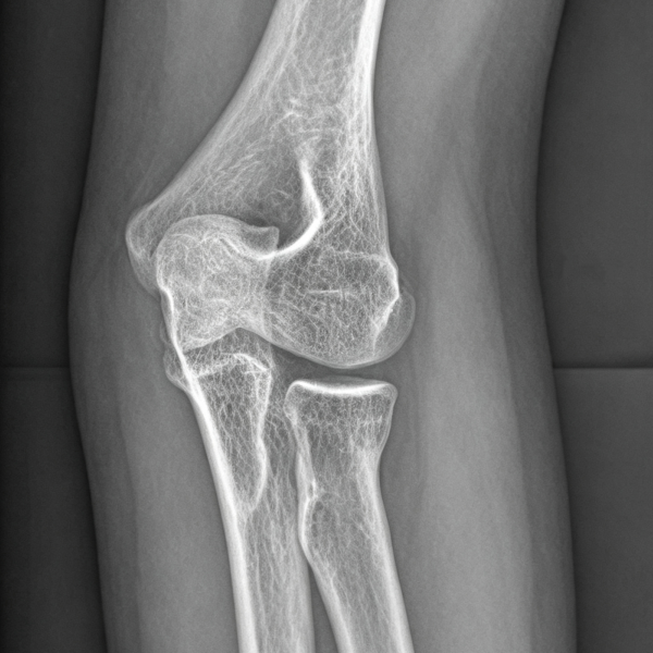 Pediatric radial neck fracture.webp