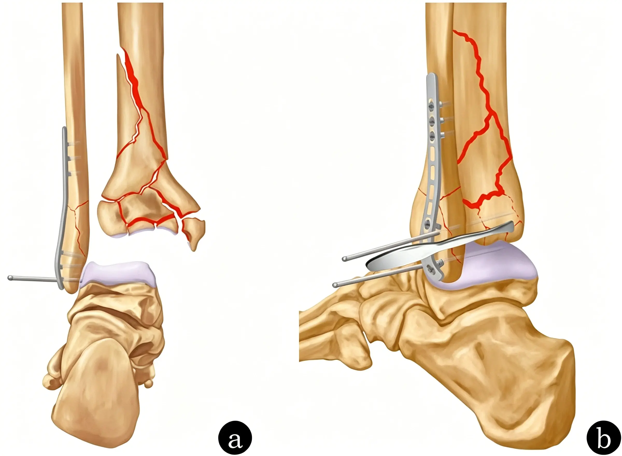Reduction and fixation of the posterior malleolus (1) (1).webp