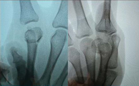 Intramedullary Screw Fixation.png