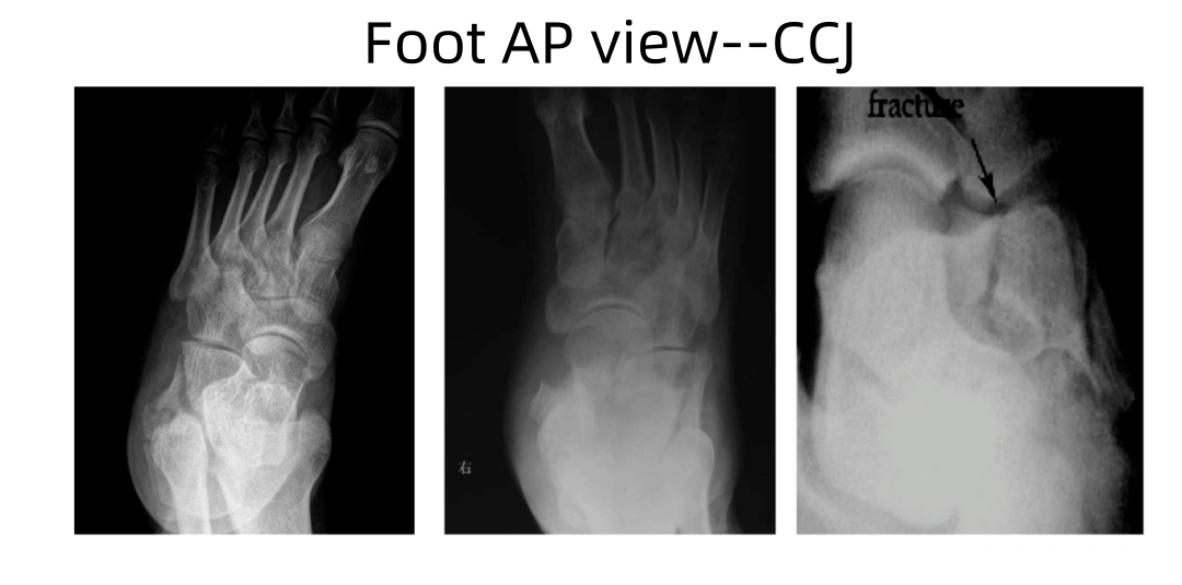 Foot AP view.webp