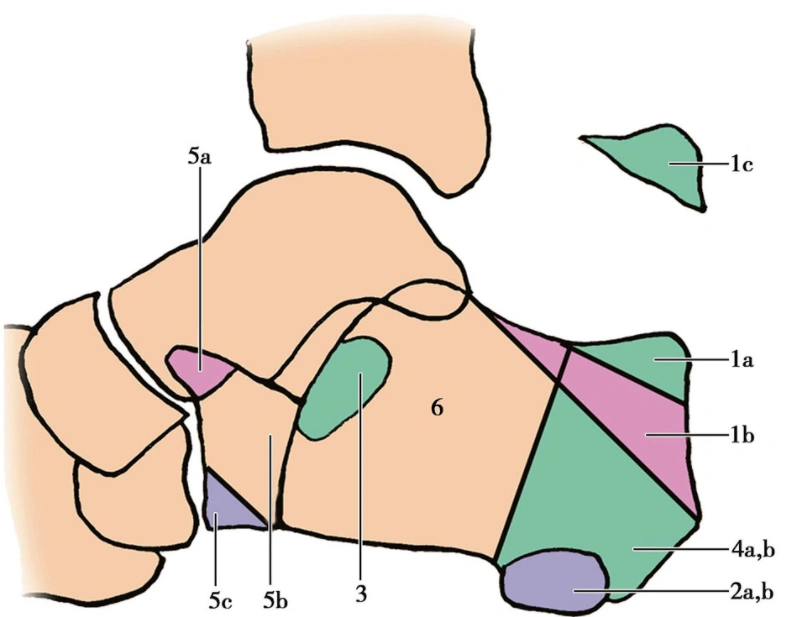 Mixed typing of extra-articular fractures (1).webp