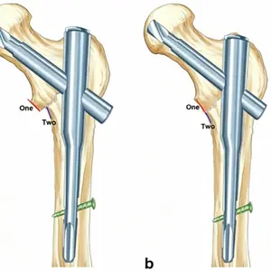 AP view of the hip fracture_副本.webp