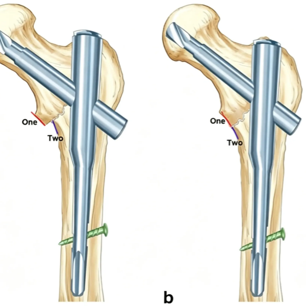AP view of the hip fracture_副本.webp