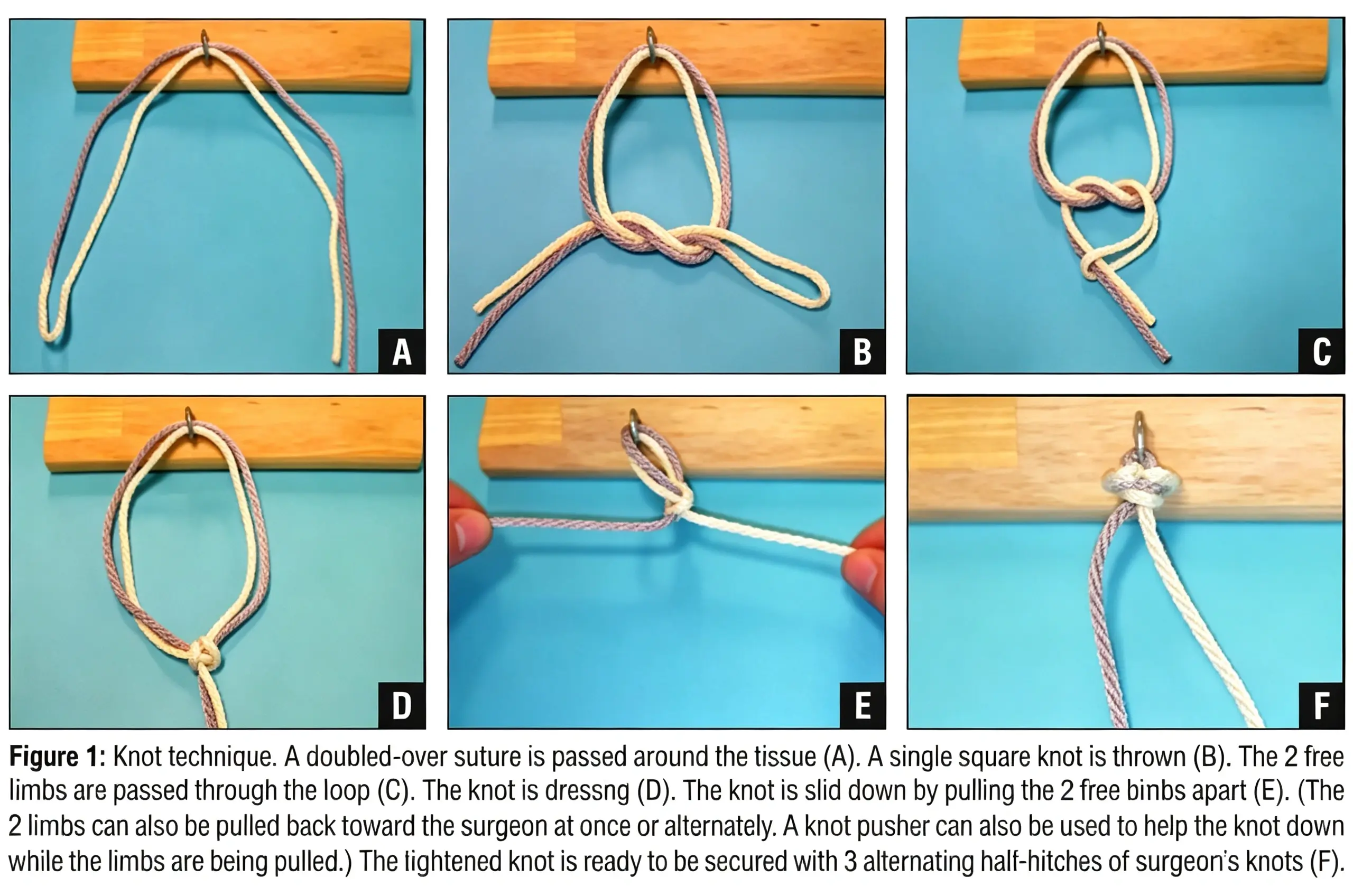 The Doubled-Suture Nice Knot.webp