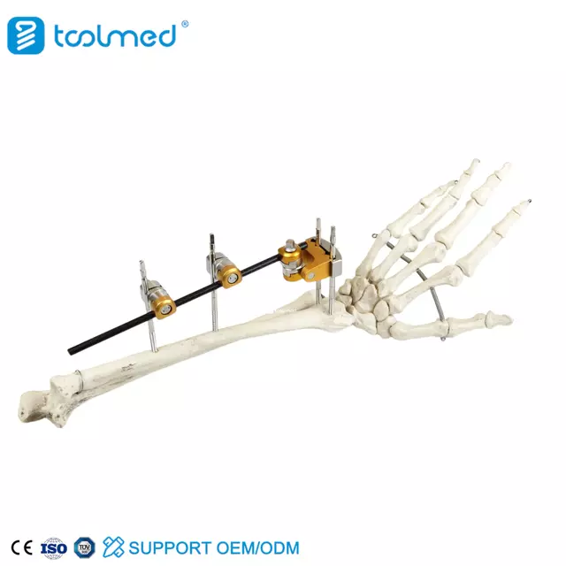 UIna & Radius External Fixator 
