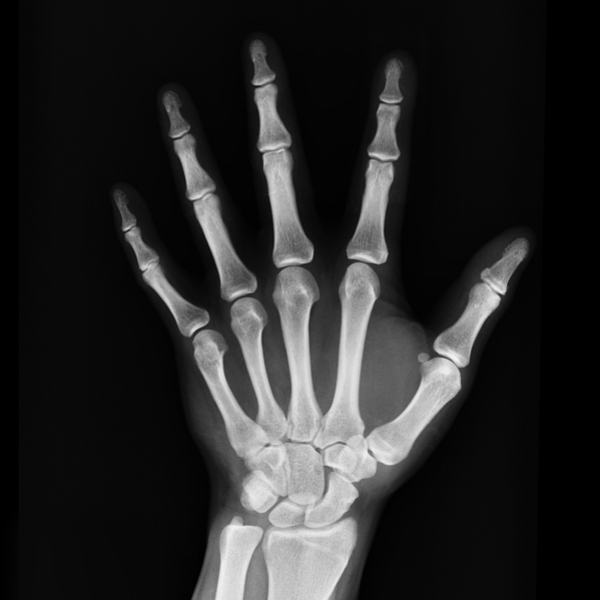 metacarpal fracture.jpg