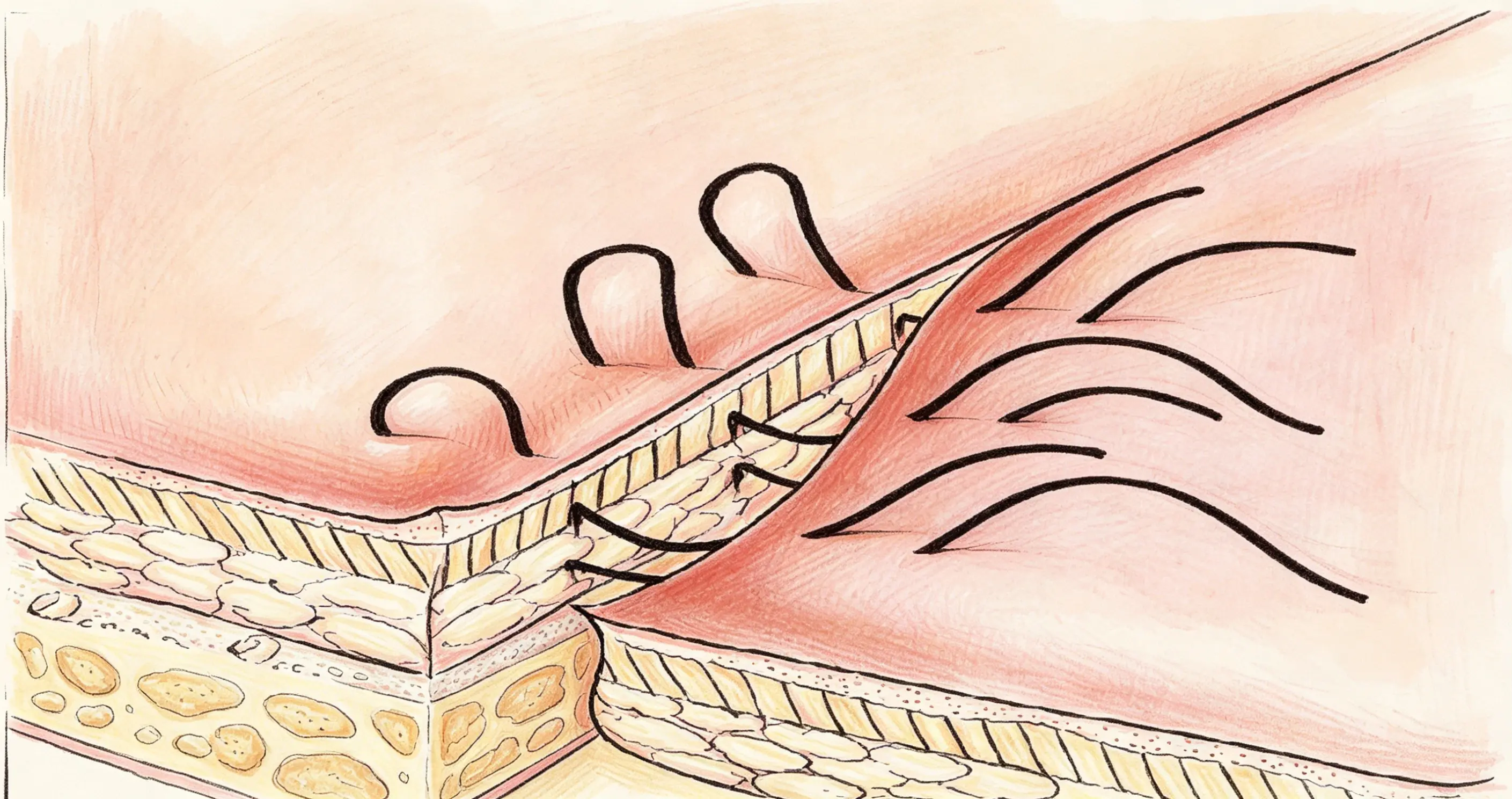 Vertical Mattress Sutures.webp