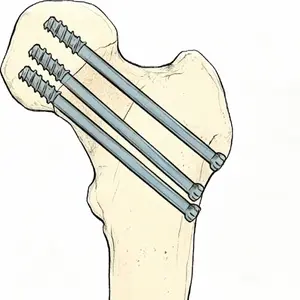 Cannulated screw fixation_副本.webp