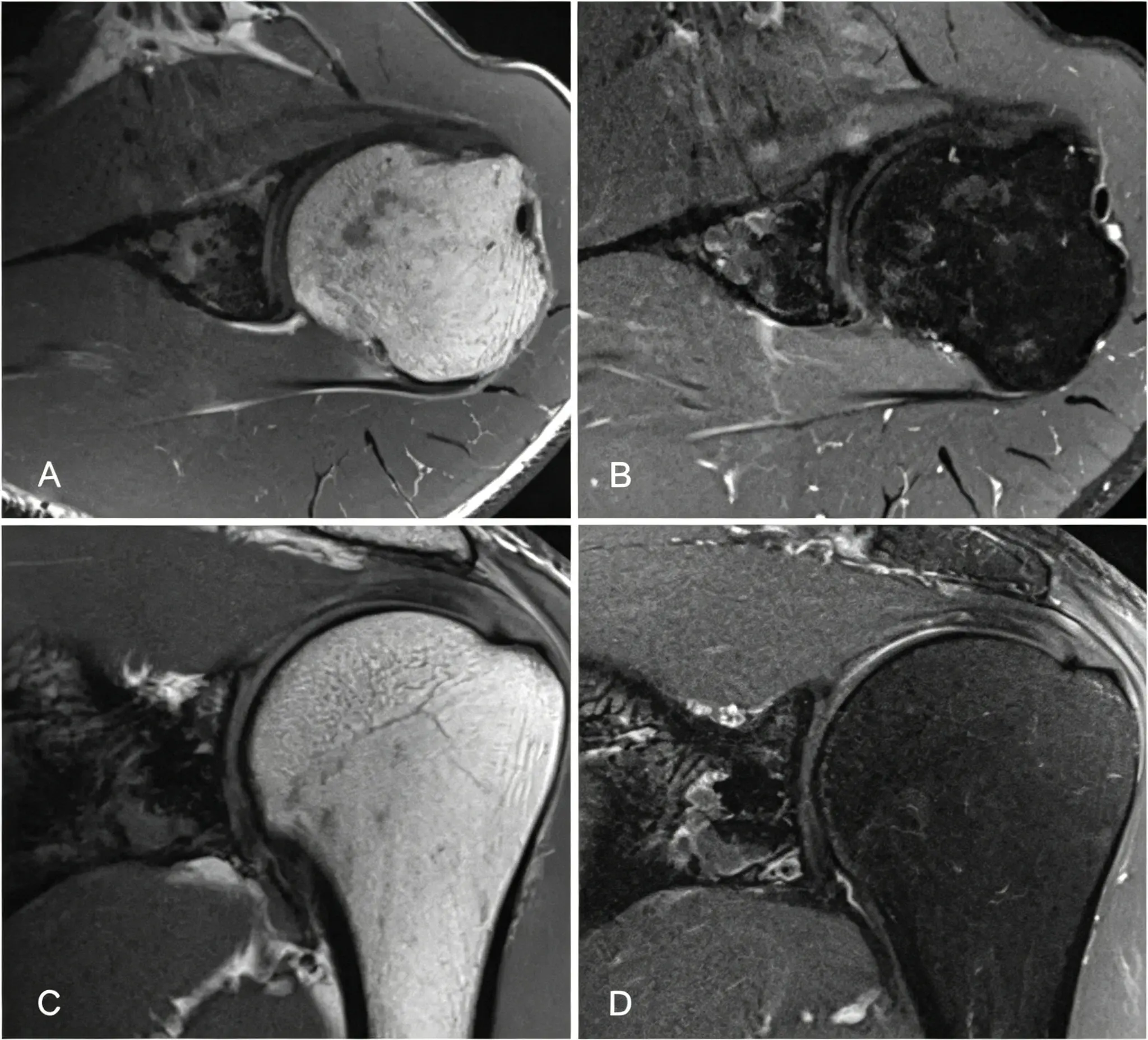 Left shoulder MRI examination.webp