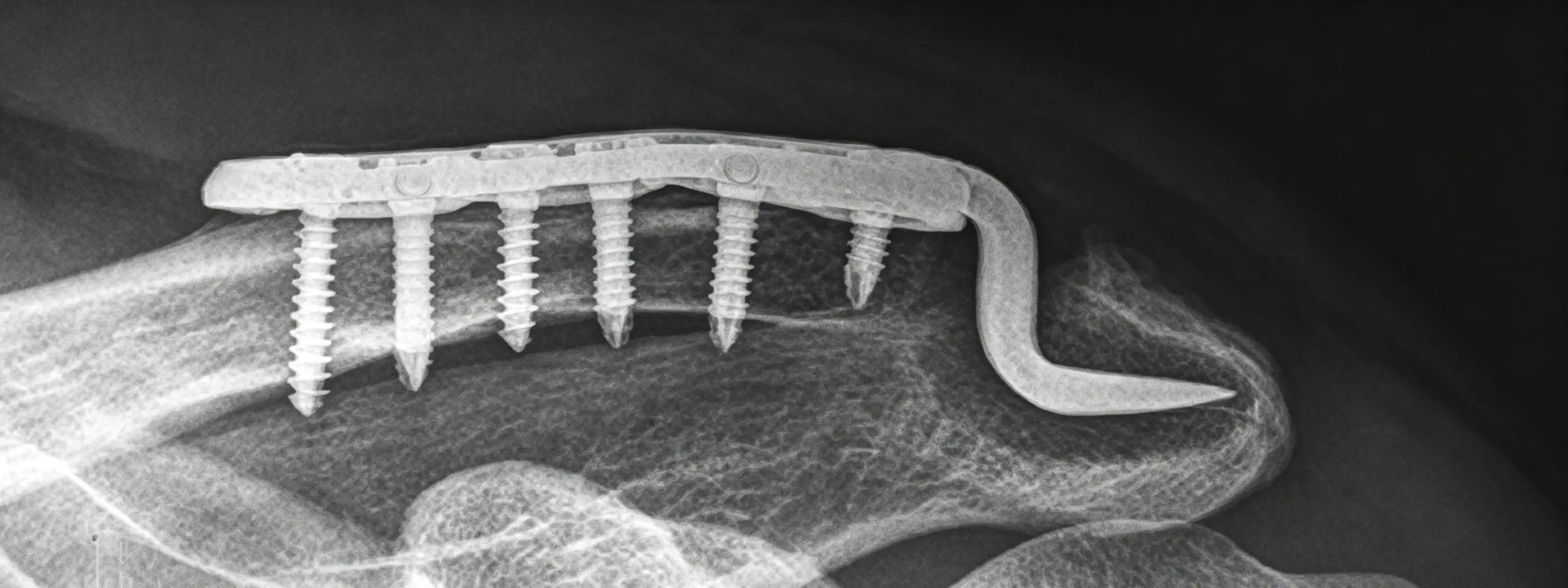 Imaging of subacromial osteolysis.webp